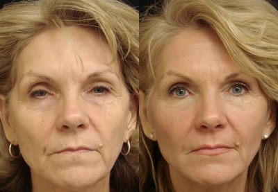 Non-surgical face lift - 	This 60 year old had sagging skin, blotchy skin, wrinkles and loss of facial volume. She began using the New Youth Cosmeceuticals followed by the Fraxel Restor laser. She then had two sessions of Sculptra injections to revoluminze her face.