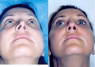 Rhinoplasty - This is a 32 year old patient that had rhinoplasty at a different practice 10 years prior. She was unhappy with the general appearance and the long length of the tip.
