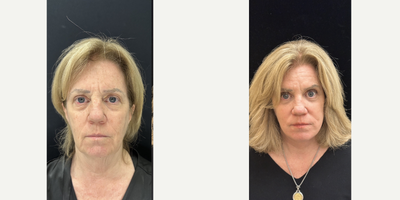 55-64 year old woman treated with Deep Plane Facelift, Eyelid Surgery - 60 year-old female, who is 3 months after Deep Plane Facelift Necklift upper and lower blepharoplasty and facial fat transfer.