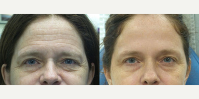 45-54 year old woman treated with Xeomin - This patient was concerned with deep wrinkles in her forehead and around her eyes. She was treated with Xeomin.