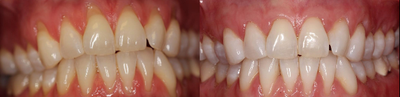 25-34 year old woman treated with Gum Graft - This patient was unhappy with her gum recession. Her teeth were sensitive and she did not like the look. We were able to restore her gums to the correct level with our periodontists.