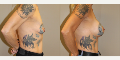 45-54 year old woman treated with Mentor Breast Implants - After 3 children and volume loss to her breasts, this 47-year-old came in to discuss breast augmentation with Dr. Leonard. She wanted a natural result, and after discussing the different implant options available, a Mentor shaped high profile 430cc implant was used. At her 6-month post-op appointment, she was very happy with her results.