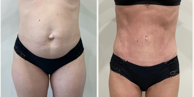 25-34 year old woman treated with Drainless Tummy Tuck - Drainless Abdominoplasty