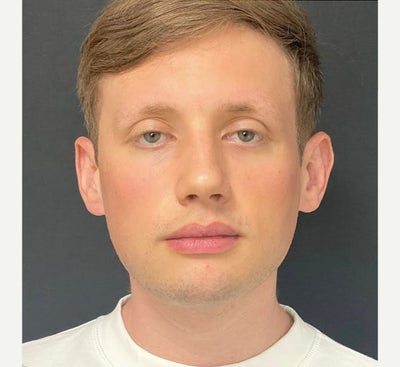 25-34 year old man treated with Buccal Fat Removal - Buccal Fat Removal