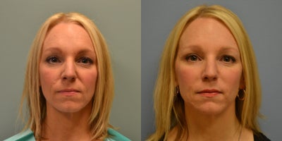 45 year old woman treated with Voluma - 45 year old female received Voluma XC to contour cheekbones and create a more youthful profile
