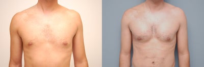 Pectoral Implants - Pectoral Implants
