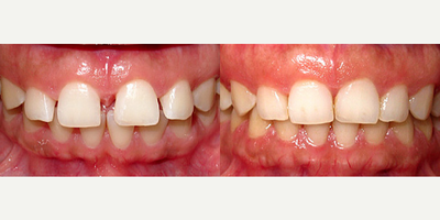 Invisalign - Invisalign