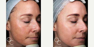 Woman treated with LaseMD - Woman treated with LaseMD