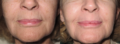 55-64 year old woman treated with Fractional Laser - Fractional carbon dioxide laser to the peri-oral region