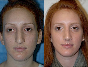 Woman treated with Septoplasty and Rhinoplasty - Woman treated with Septoplasty and Rhinoplasty