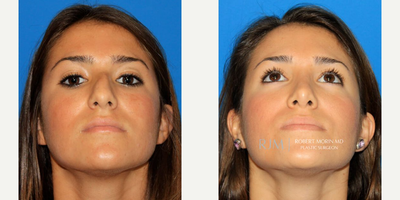 18-24 year old woman treated with Rhinoplasty, Septoplasty - Patient's 3 Story: A rhinoplasty and septoplasty was performed on this 19 year old college student with a history of nasal trauma. Surgical correction of her deviated nose, dorsal hump and bulbous tip was performed. These procedures resulted in a straight nose, a smooth flat nasal dorsum, better tip projection and definition and an overall beautiful result.