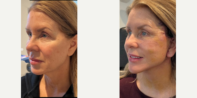 Woman treated with Neck Lift, Facelift - One week out from extended deep plane facelift and neck lift surgery, along with lower blepharoplasty, this lovely patient is doing very well.I have compiled a collection of photos to demonstrate (early) before and after, incision locations, techniques applied, side-by-side results.
