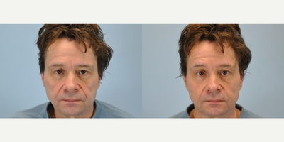 53 year old man treated with Voluma - This 53 year old was treated with Juvederm and Voluma.