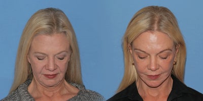 Woman treated with Deep Plane Facelift - Woman treated with Deep Plane Facelift