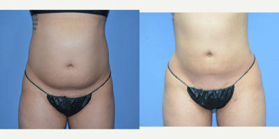 25-34 year old woman treated with BodyTite - 26 year old female shown 6 months after lipo 360 with BodyTite treatment. She had 4 L of fat removed.