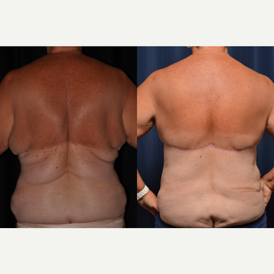 65-74 year old woman treated with Body Lift - Patient underwent upper back lift with liposuction. No drain was used.