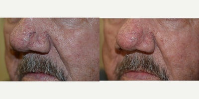65-74 year old man treated with Laser - Dilated small veins and capillaries are unwanted. Immediately after laser treatment with our Varilight laser these are less obvious.