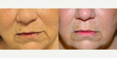 55-64 year old woman treated with Laser - Lips can sometimes form a 'venous lake' which is a dilated small vein. Immediately after treatment with our Varilight laser the dark blue color is fading and will fade more in time
