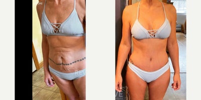 35-44 year old woman treated with Tummy Tuck, Breast Augmentation, Liposuction, Brazilian Butt Lift - 35 year old woman treated with Tummy Tuck, Breast Augmentation, Lipo 360 and Brazilian Butt Lift