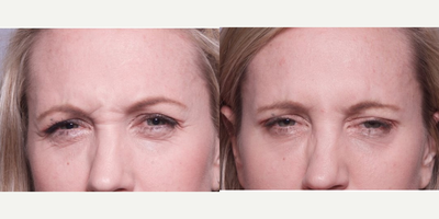 35-44 year old woman treated with Dysport - This patient came in to address her dynamic expression. After consulting with Dr. Ho, she elected to receive a Dysport treatment to soften the look of the area.