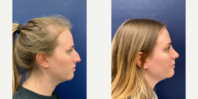 25-34 year old woman treated with Rhinoplasty - 6 weeks post-op Rhinoplasty by Dr. Butler
