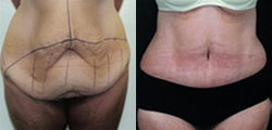 Panniculectomy - Panniculectomy