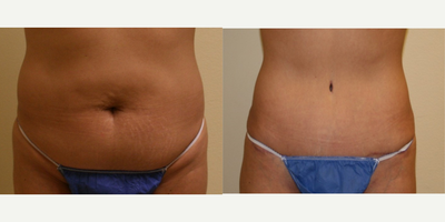 35-44 year old woman treated with Tummy Tuck Revision - Tummy Tuck