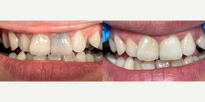 25-34 year old woman treated with Internal Tooth Bleaching, Tooth Repair - We treated our patient with internal tooth bleaching and applied dental filler.