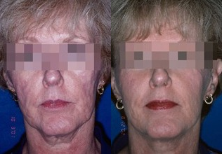 55 year old woman treated with subcision for acne scars - Subcision is a great technique to permanently improve rolling, depressed acne scars.
