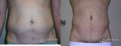 25-34 year old man treated with Liposculpture - 25-34 year old man treated with Liposculpture