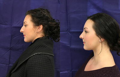 Woman treated with Rhinoplasty - Woman treated with Rhinoplasty.