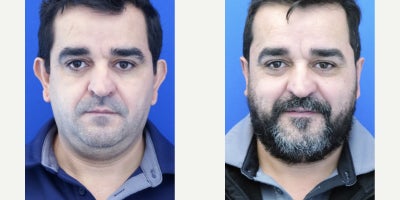 45-54 year old man treated with Ear Surgery - Three things are desired and corrected in this patient: antihelix creation and ear pinning, then earlobe reduction. At only 10 days post-op the result is evident albeit earlobe is still swollen. At 4 years out he is super appreciative of the long term aesthetic result.