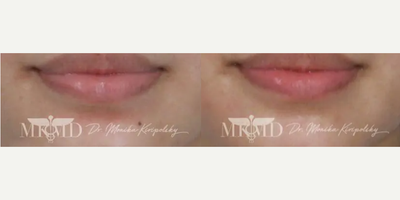 Woman treated with Mole Removal - Gender: FemaleEthnicity: CaucasianAge: 26 - 30Procedure: Mole & Melanoma Removal