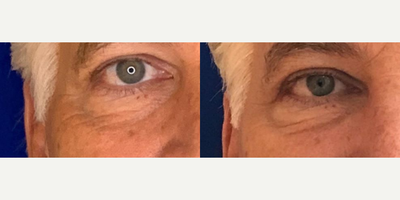 60 year old man treated with Dysport - 60 year old man treated with Dysport to the forehead, crows feet and glabella