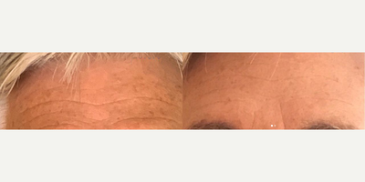 60 year old woman treated with Dysport - 60 year old woman treated with Dysport to the forehead, crows feet and glabella.
