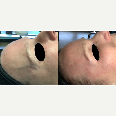 Female treated with Face Sclerotherapy - Before and after only 1 treatment of face sclerotherapy! Amazing results