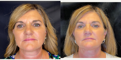 55-64 year old woman treated with AccuTite - ACCUTITE + FACETITE -Minimally invasive neck and face contouring. This patient had Accutite of the nasolabial folds and FaceTite to her jawline, neck and jowls.FaceTite provides dramatic improvement in skin laxity on the face and neck, which was previously only attainable through a surgical procedures such as a facelift. FaceTite is a minimally invasive system to tighten and firm up skin of the lower face and neck in just one, short treatment. The device uses advanced radio frequency energy technology: Radio-Frequency Assisted Lipolysis (RFAL), delivering precision heating to the deeper skin layers, triggering natural regeneration, and gently melting away excess fat.At Modern Women's Health, we utilize this minimally invasive technology to sculpt and define the lower face and neck. Unlike a facelift surgical procedure, these patients will be scar free and will benefit from reduced post-procedural swelling and discomfort while maintaining their natural appearance. This less traumatic process yields a natural-looking final result, improving your appearance without changing the way you look. Results can be seen immediately, and continue to improve for a year after treatment. Results can last from 3-5 years with the proper maintenance (sunscreen, skin care, facials, etc...).-Sagging Jowls-Nasolabial folds (excessive smile wrinkles)-Aging neck -Sagging JawlineHOW QUICKLY WILL I SEE RESULTS? Results can be seen immediately, with best results noticeable after 6-12 weeks. This varies greatly from patient to patient, however, so we can answer this for you specifically when you come in for a consultation. WHAT KIND OF PROCEDURE CARE IS REQUIRED? FaceTite is a minimally-invasive procedure performed in the office with local anesthetic and oral medication to keep you comfortable. Post-procedure, the patient can go home and resume regular activities shortly after. Wearing a compression garment for 48 hours post treatment is required for best results.