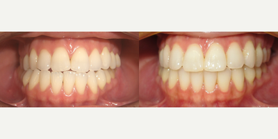25-34 year old woman treated with Lingual Braces - Underbite, Incognito, 30 months