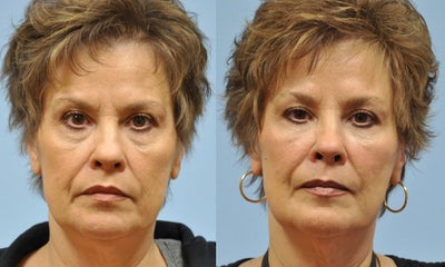 56 year old woman treated for forehead creases and lower eyelid hollowing - Botox was used to soften the forehead and glabellar creases which makes her look less angry.  Juvederm was used to revolumize the cheeks and reduce lower eyelid hollowing.  Juvederm was also used to soften the marionette lines on the chin.