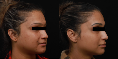 35-44 year old woman treated with Jessner Peel, Skin Rejuvenation - Patient treated for Adult Acne and Post Inflammmatory Hyperpigmenation due to acneic condition. The patient had a series of Q-Switched toning and peels to control acne and to even out the skin tone by reducing pigmented skin.