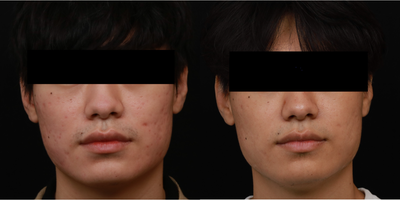 25-34 year old man treated for Acne scarring with a Combination Treatment Approach - Patient was treated with Fraxel re:store (non-ablative laser resurfacing) , Intracel (microneedling with radio frequency) as well as Platelet-Rich Plasma to address acne scarring. Photos show an improvement in textural irregularities and smoother skin.