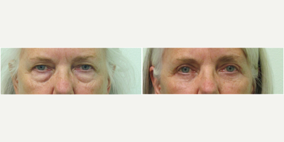55-64 year old woman treated with Upper and Lower Blepharoplasty - This woman presented to our Center with the request of rejuvenating her upper and lower eyes.  She felt that her eyes always looked tired regardless of how much sleep she had nightly.  We agreed that treating both her upper eyelids (skin removal) and lower eyelids (fat bag removal) would help make her appear more awake and refreshed.  The procedures were performed under local anesthesia (with mild oral sedation with xanax) in our office.  Her results demonstrate significant improvement in the contour (ie puffiness) under her eyes, as well as opening her upper eyes so that the lids can now be seen.  She stated that she felt physically less tired on a daily basis since she no longer had the upper eyelid skin sitting on her eye and creating downward pressure.  The procedure time was under two hours, and her sutures were removed after five days.