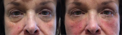 65 Year Old Woman treated with Sculptra - 
	Immediately after treatment. 1 vial of Sculptra.
