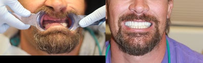 All-on-4 Dental Implants  - The All-on-4 is the modern solution for all missing teeth. This treatment concept replaces your missing teeth with a Full Dental Bridge, No Palate, No Excess Material, Not Removable, and supported by only Four Specialty Dental Implants, with two of the Implants placed at precise angles. With less implants needed, overall treatment time is reduced. The unique All-on-4 solution also ensures greater stability in the bone, reducing the need for bone graft surgery to increase bone volume. Your teeth will look, feel and are brushed much like natural teeth, and you can lead a normal life immediately after a 1 Day surgery. Studies indicate that Patients receive 90-95% chewing ability. Your quality of life is improved and you can start enjoying your favorite foods again.