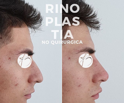 18-24 year old man treated with Nonsurgical Nose Job - Male patient treated with hyaluronic based filler