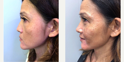 45-54 year old woman treated with Voluma - The patient is a 45-55 year old female treated with Voluma injections to the lips, collumella of the nose, and cheeks.