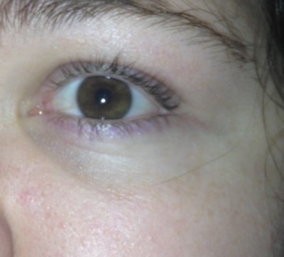What is this purple color under my eyes? (photos) Doctor Answers, Tips