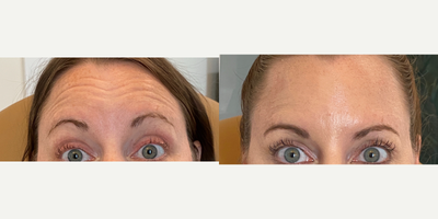 35-44 year old woman treated with Jeuveau, Dysport, Botox - This client had Jeuveau placed in her forehead and around her eyes for her crows feet to soften her lines.