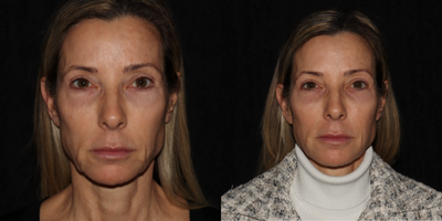 45-54 year old woman treated with Sofwave - This lovely client is just 2 weeks out from her Sofwave treatment and already we are seeing the benefits of tightening and smoothing of the skin around her mouth and under her eyes. Her results will continue to improve over the following 6 months, this is not her final result!
