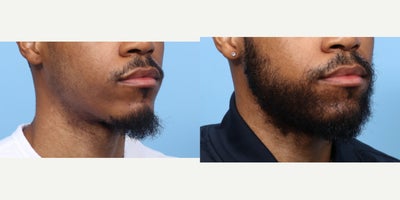 25-34 year old man treated with Beard Transplant, Hair Transplant, Hair Loss Treatment, PRP Injections, PRP for Hair Loss - This patient wanted to fill in the sparse area of hair around his lips. Dr. Wise performed an FUE hair transplant, placing 2,550 grafts to the beard area giving the patient the results he desired.